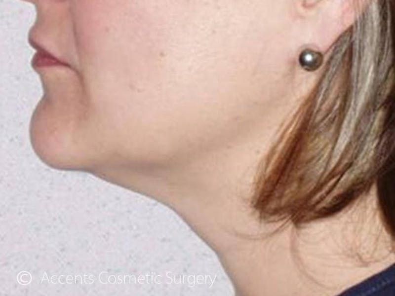 Thermage Face And Neck Before & After Gallery - Patient 272436 - Image 2
