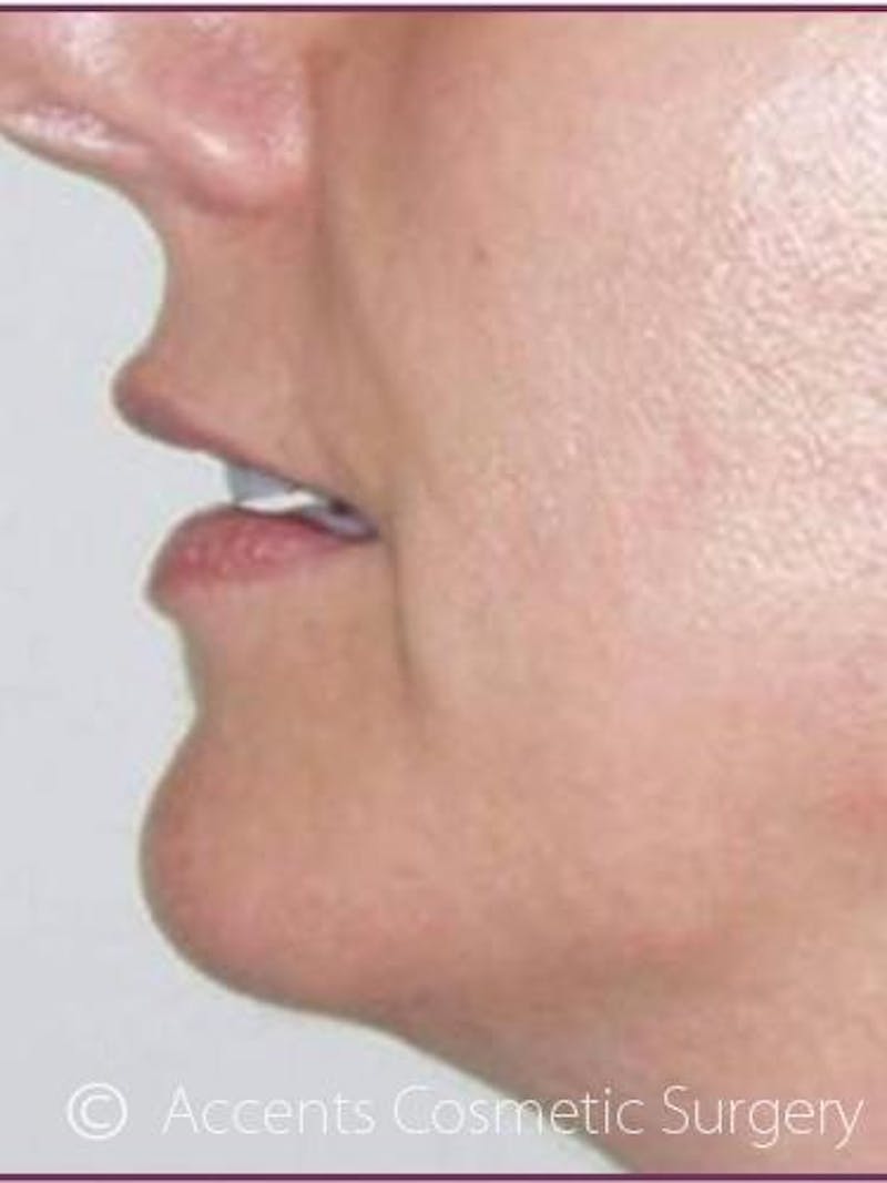 Thermage Face And Neck Before & After Gallery - Patient 230780 - Image 1