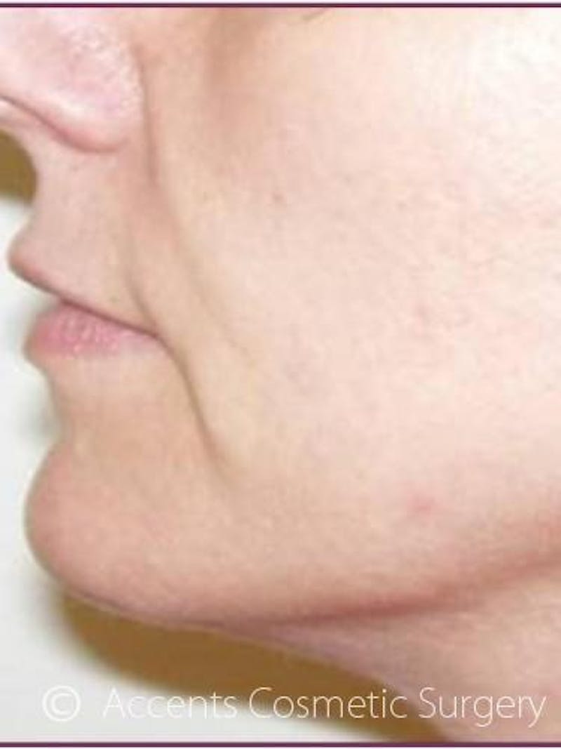 Thermage Face And Neck Before & After Gallery - Patient 230780 - Image 2