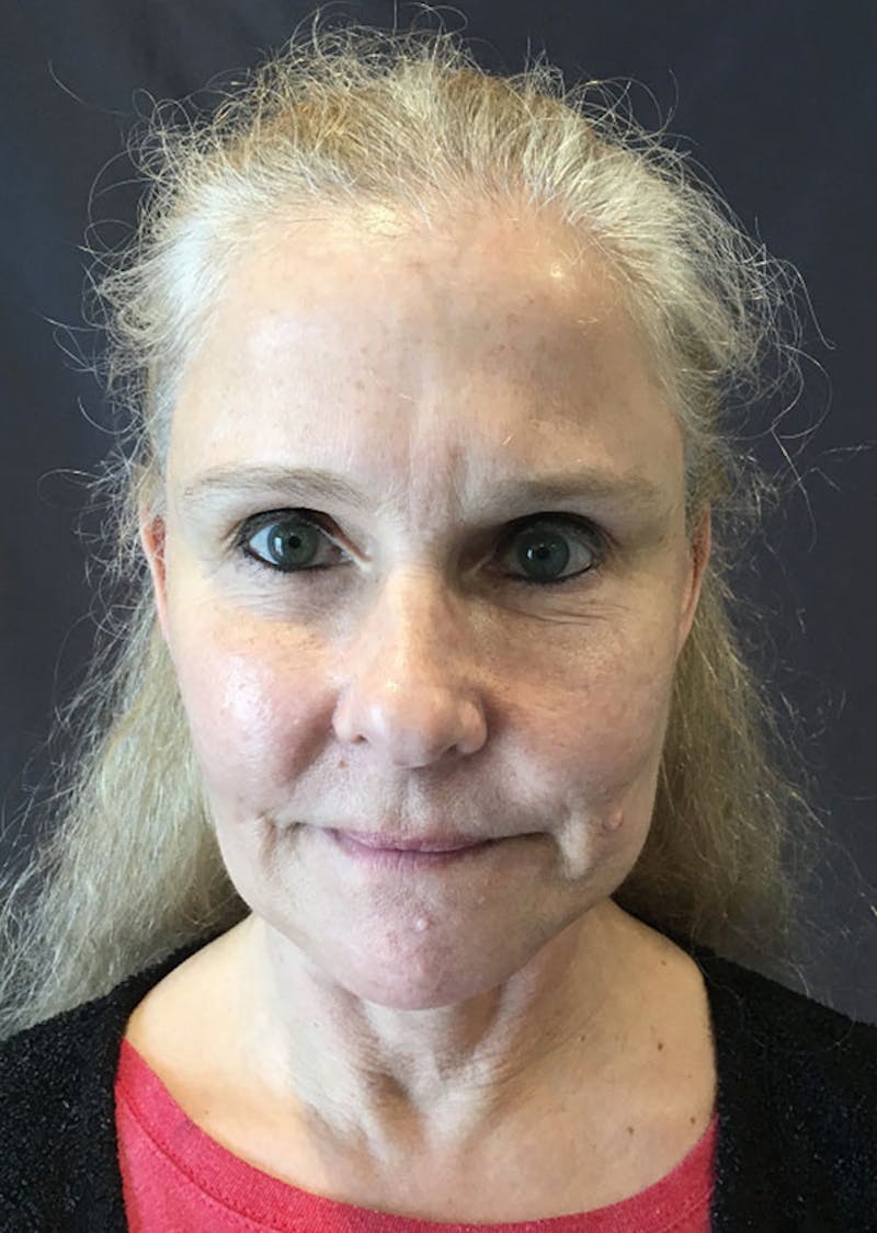 Thread Lift Facelift Before & After Gallery - Patient 306855 - Image 1