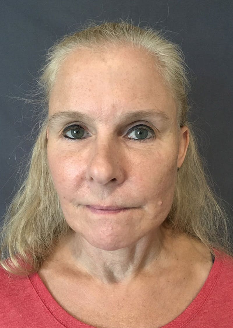 Thread Lift Facelift Before & After Gallery - Patient 306855 - Image 2