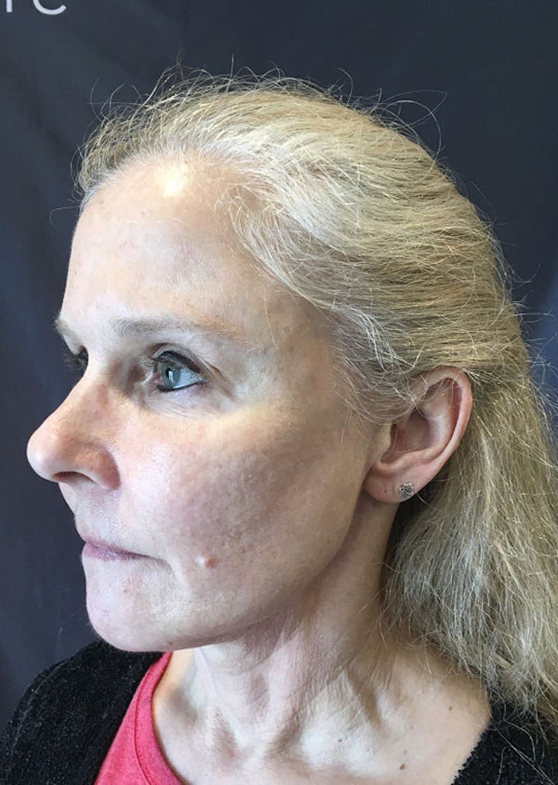 Thread Lift Facelift Before & After Gallery - Patient 306855 - Image 3