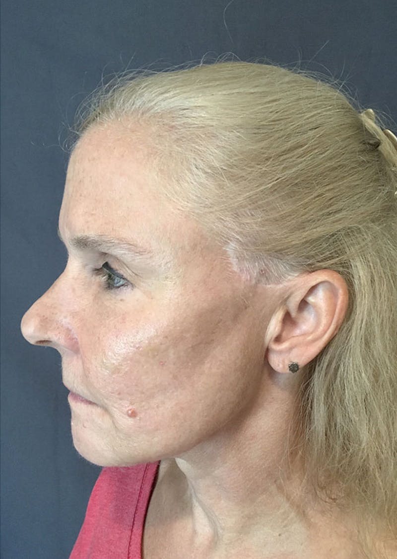 Thread Lift Facelift Before & After Gallery - Patient 306855 - Image 4