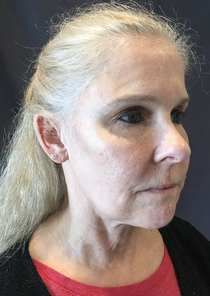 Thread Lift Facelift Before & After Gallery - Patient 306855 - Image 5