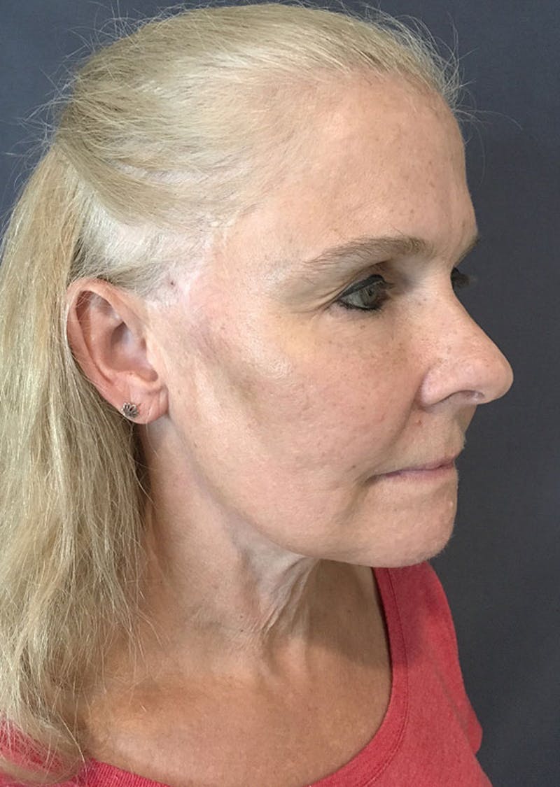 Thread Lift Facelift Before & After Gallery - Patient 306855 - Image 6