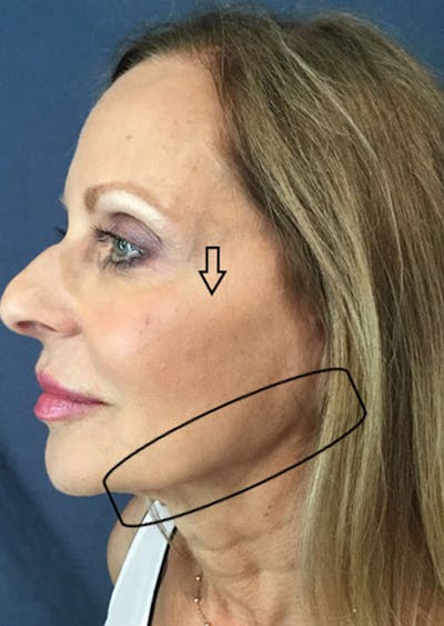 Thread Lift Facelift Before & After Gallery - Patient 313827 - Image 1