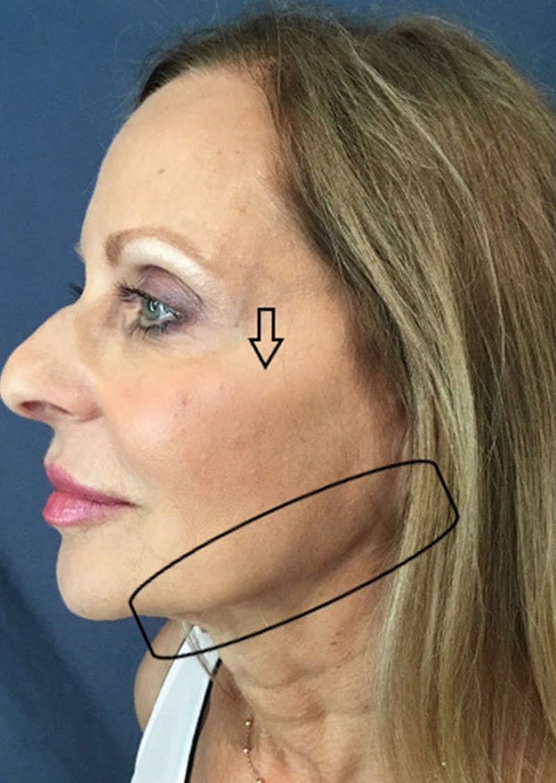 Thread Lift Facelift Before & After Gallery - Patient 313827 - Image 1
