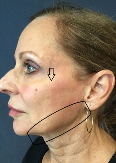 Thread Lift Facelift Before & After Gallery - Patient 313827 - Image 2