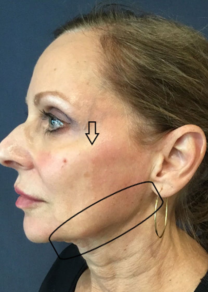 Thread Lift Facelift Before & After Gallery - Patient 313827 - Image 2