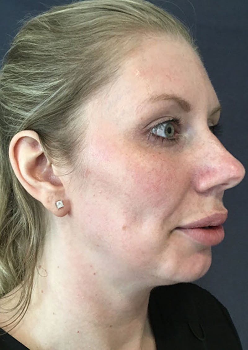 Thread Lift Facelift Before & After Gallery - Patient 299190 - Image 1