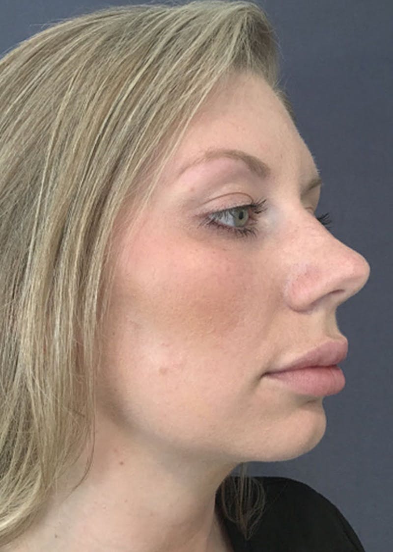 Thread Lift Facelift Before & After Gallery - Patient 299190 - Image 2