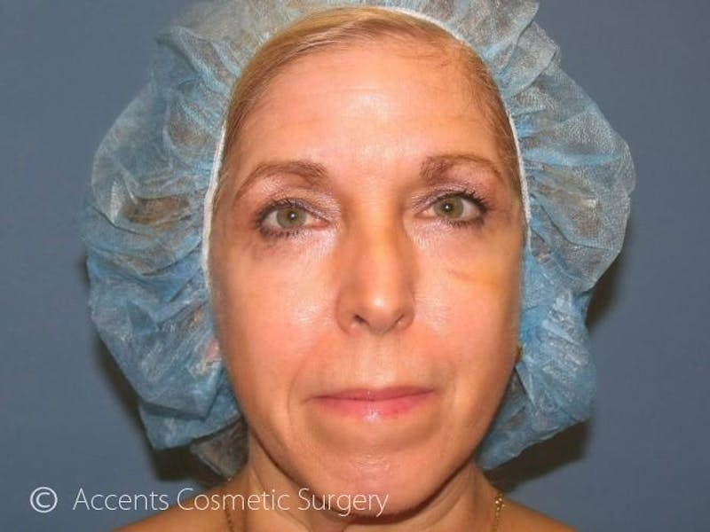 Vampire Facelift Before & After Gallery - Patient 539835 - Image 1