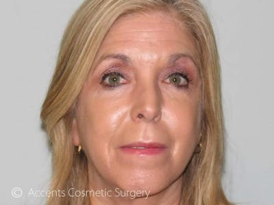 Vampire Facelift Before & After Gallery - Patient 539835 - Image 2