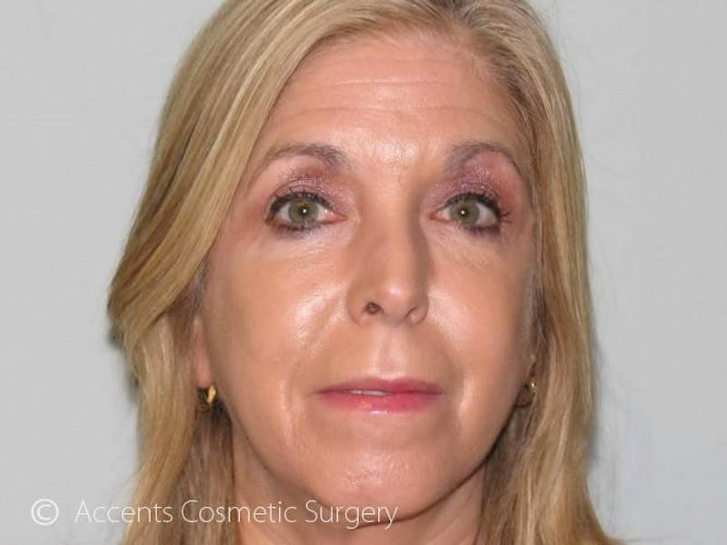 Vampire Facelift Before & After Gallery - Patient 539835 - Image 2