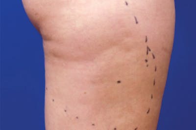 Venus Treatment Before & After Gallery - Patient 393137 - Image 1