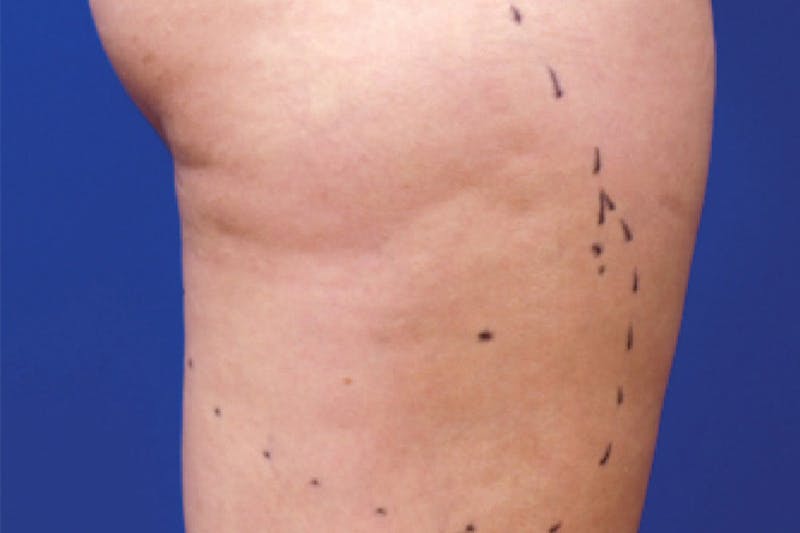 Venus Treatment Before & After Gallery - Patient 393137 - Image 1