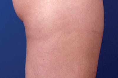 Venus Treatment Before & After Gallery - Patient 393137 - Image 2