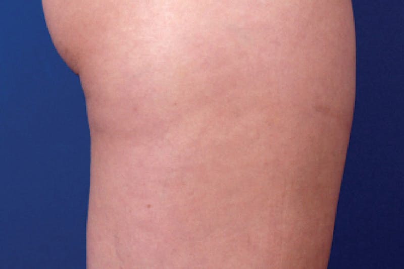 Venus Treatment Before & After Gallery - Patient 393137 - Image 2
