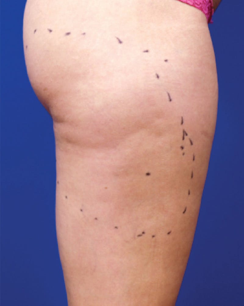 Venus Treatment Before & After Gallery - Patient 393137 - Image 3