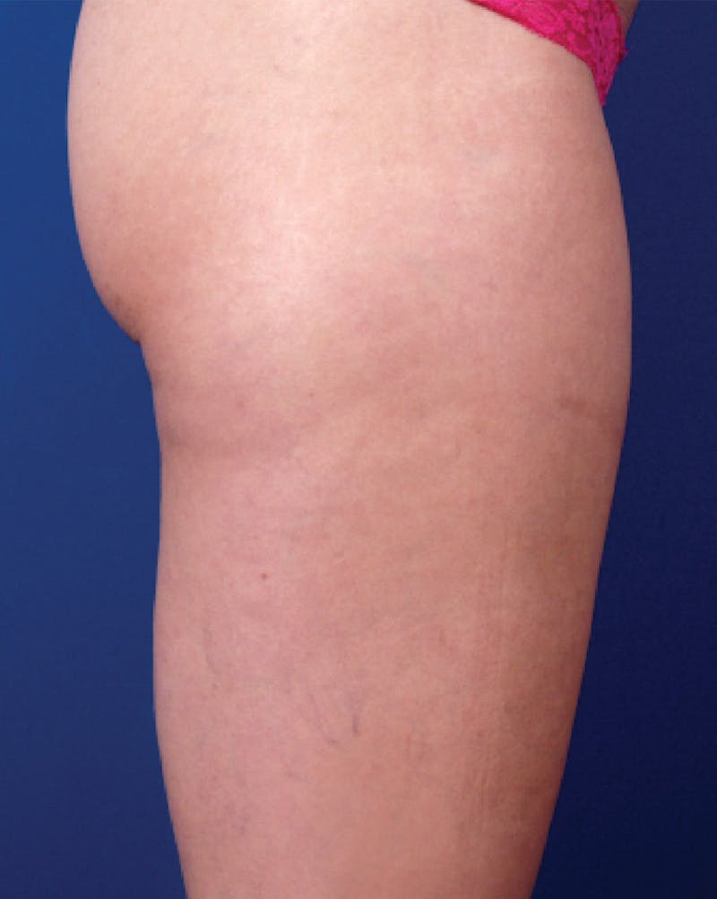 Venus Treatment Before & After Gallery - Patient 393137 - Image 4