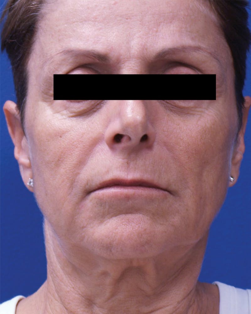 Venus Treatment Before & After Gallery - Patient 389888 - Image 1