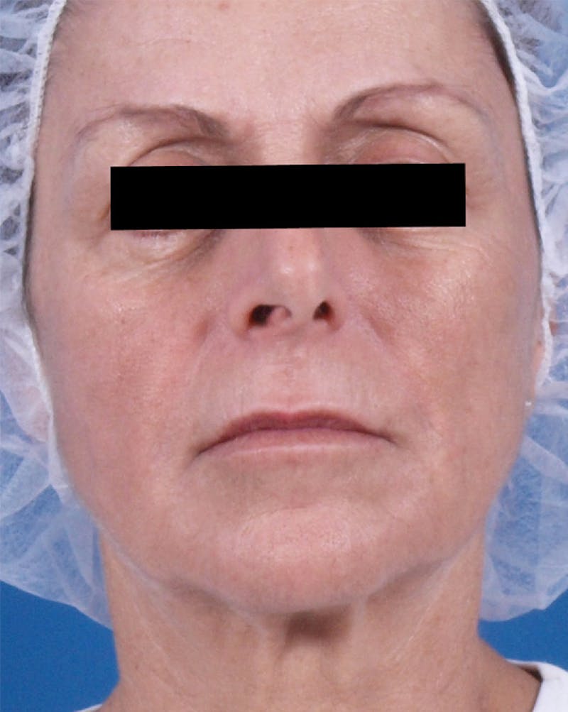 Venus Treatment Before & After Gallery - Patient 389888 - Image 2