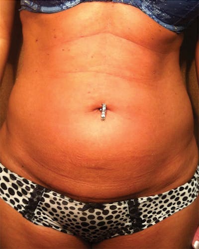Venus Treatment Before & After Gallery - Patient 417281 - Image 1