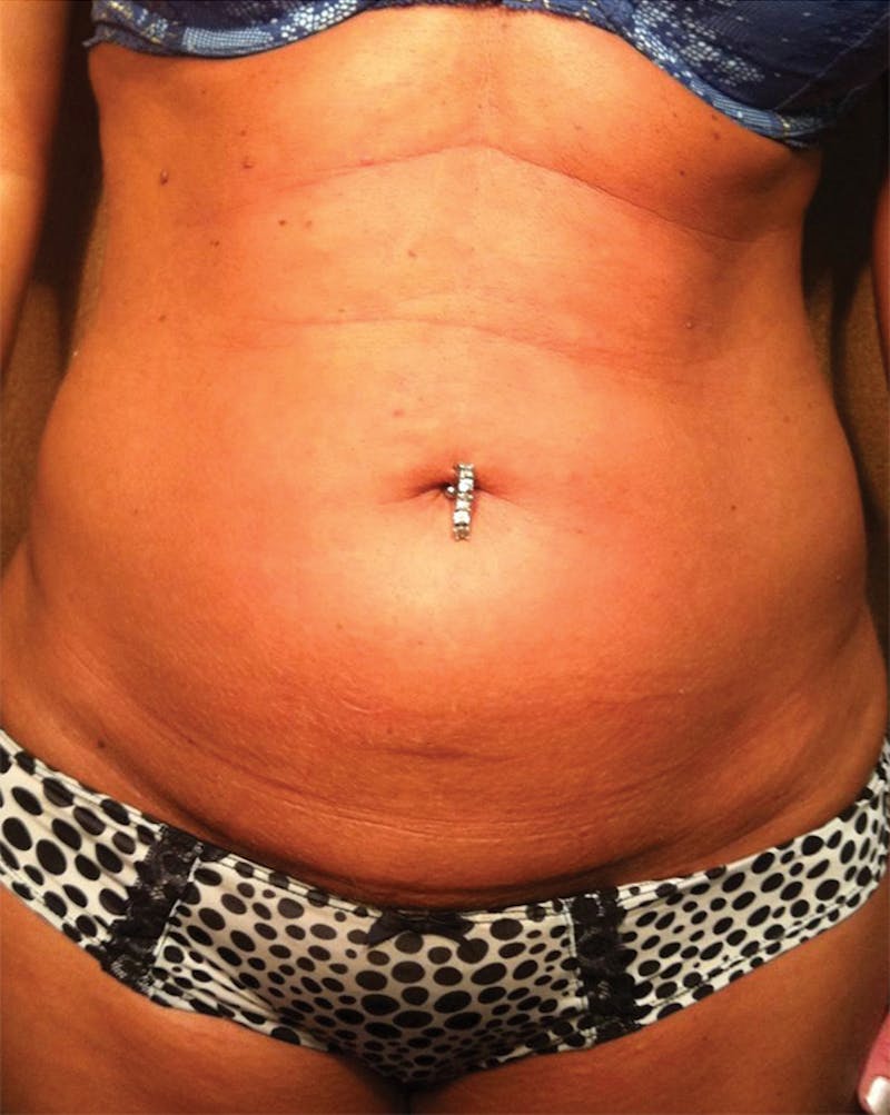 Venus Treatment Before & After Gallery - Patient 417281 - Image 1