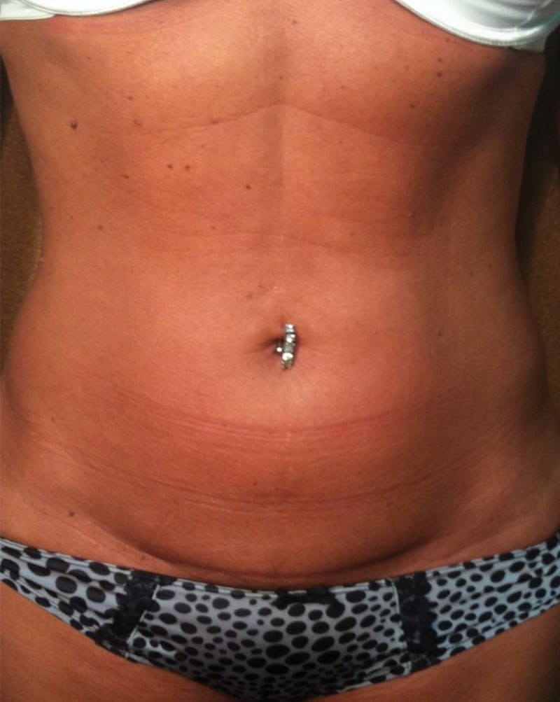 Venus Treatment Before & After Gallery - Patient 417281 - Image 2