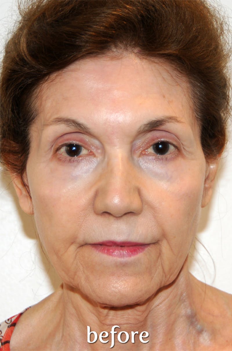 Y LIFT® Before & After Gallery - Patient 321068 - Image 1