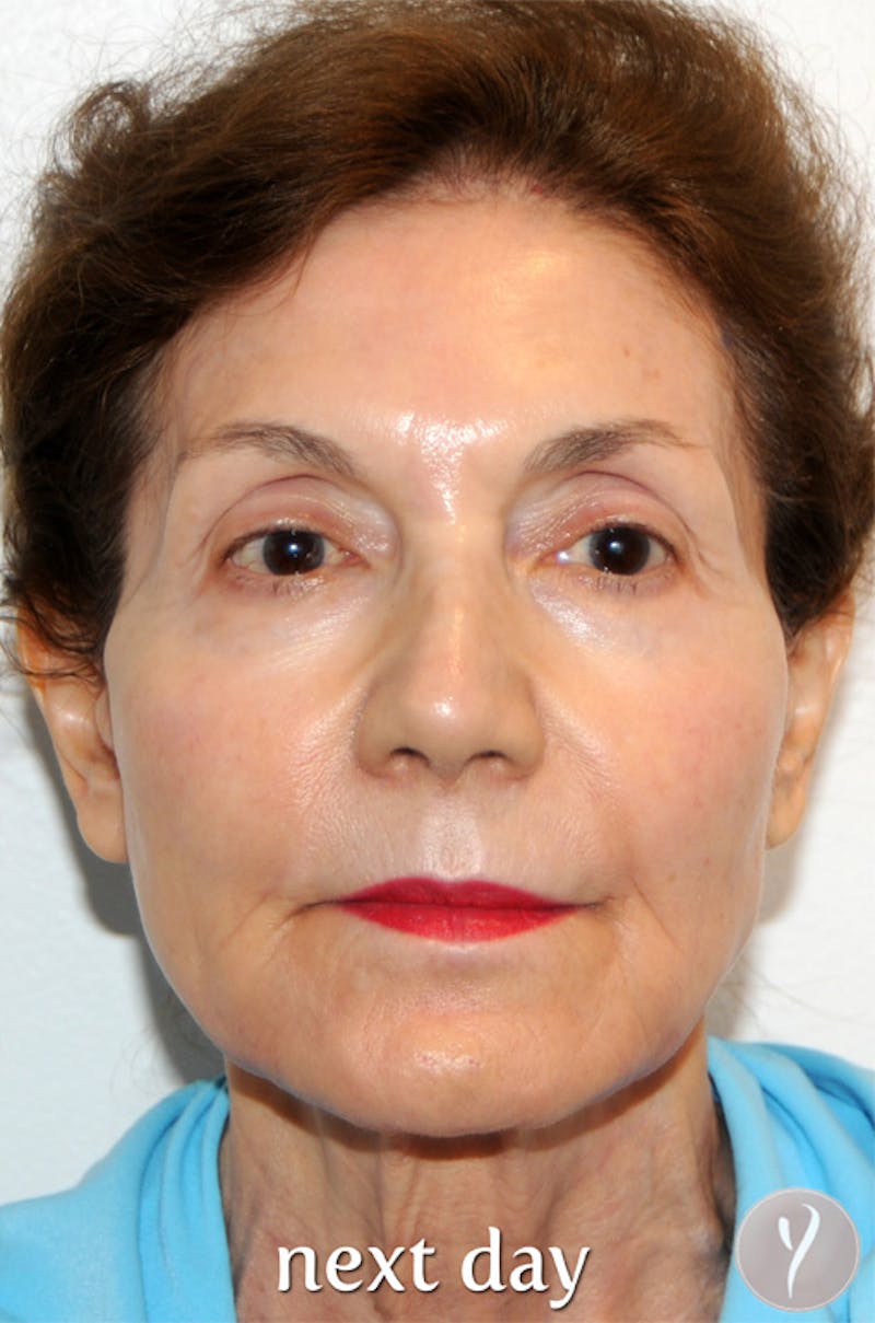 Y LIFT® Before & After Gallery - Patient 321068 - Image 2