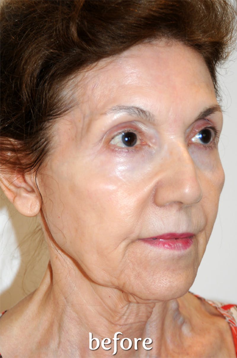 Y LIFT® Before & After Gallery - Patient 321068 - Image 3
