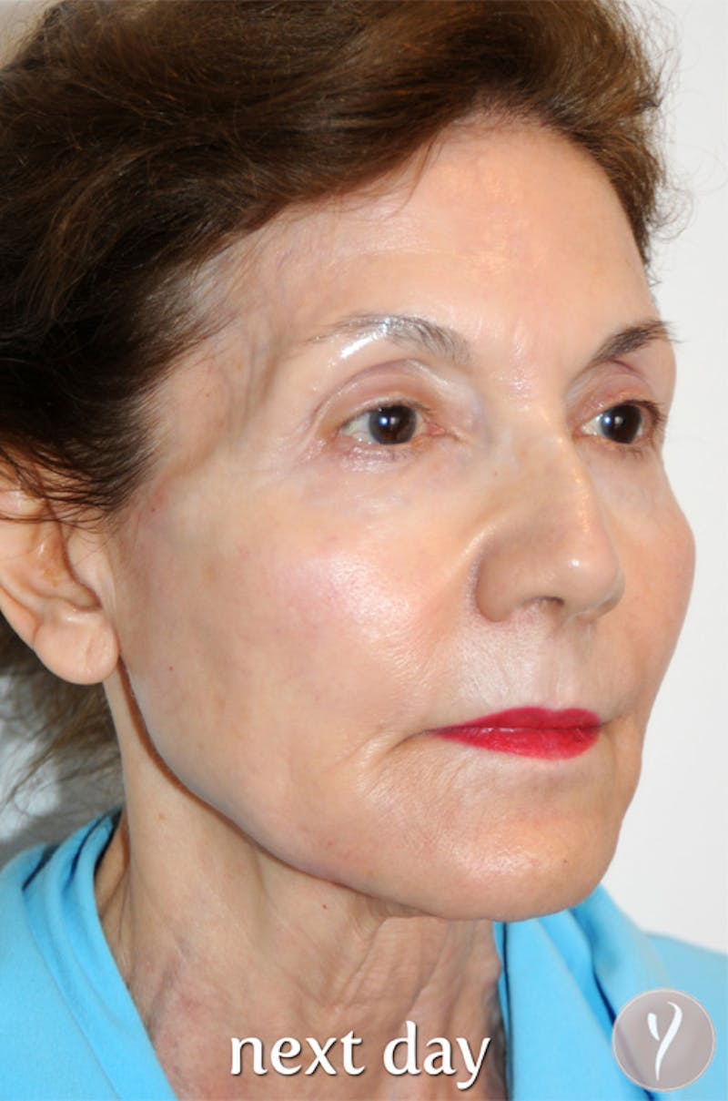 Y LIFT® Before & After Gallery - Patient 321068 - Image 4