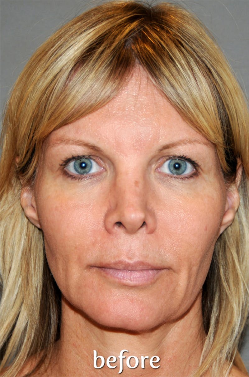 Y LIFT® Before & After Gallery - Patient 407546 - Image 1