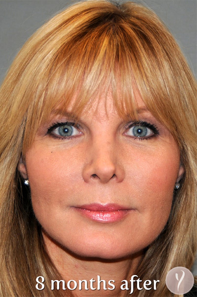 Y LIFT® Before & After Gallery - Patient 407546 - Image 2