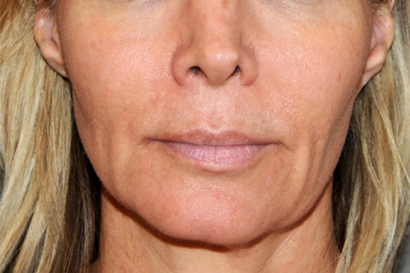 Y LIFT® Before & After Gallery - Patient 407546 - Image 3