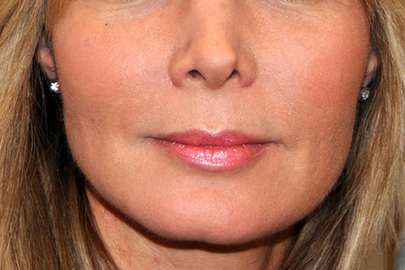Y LIFT® Before & After Gallery - Patient 407546 - Image 4