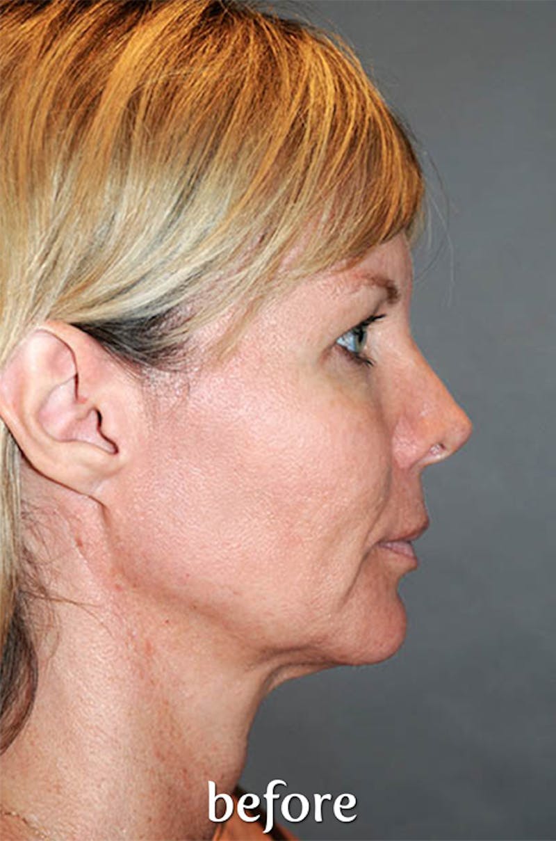 Y LIFT® Before & After Gallery - Patient 407546 - Image 5