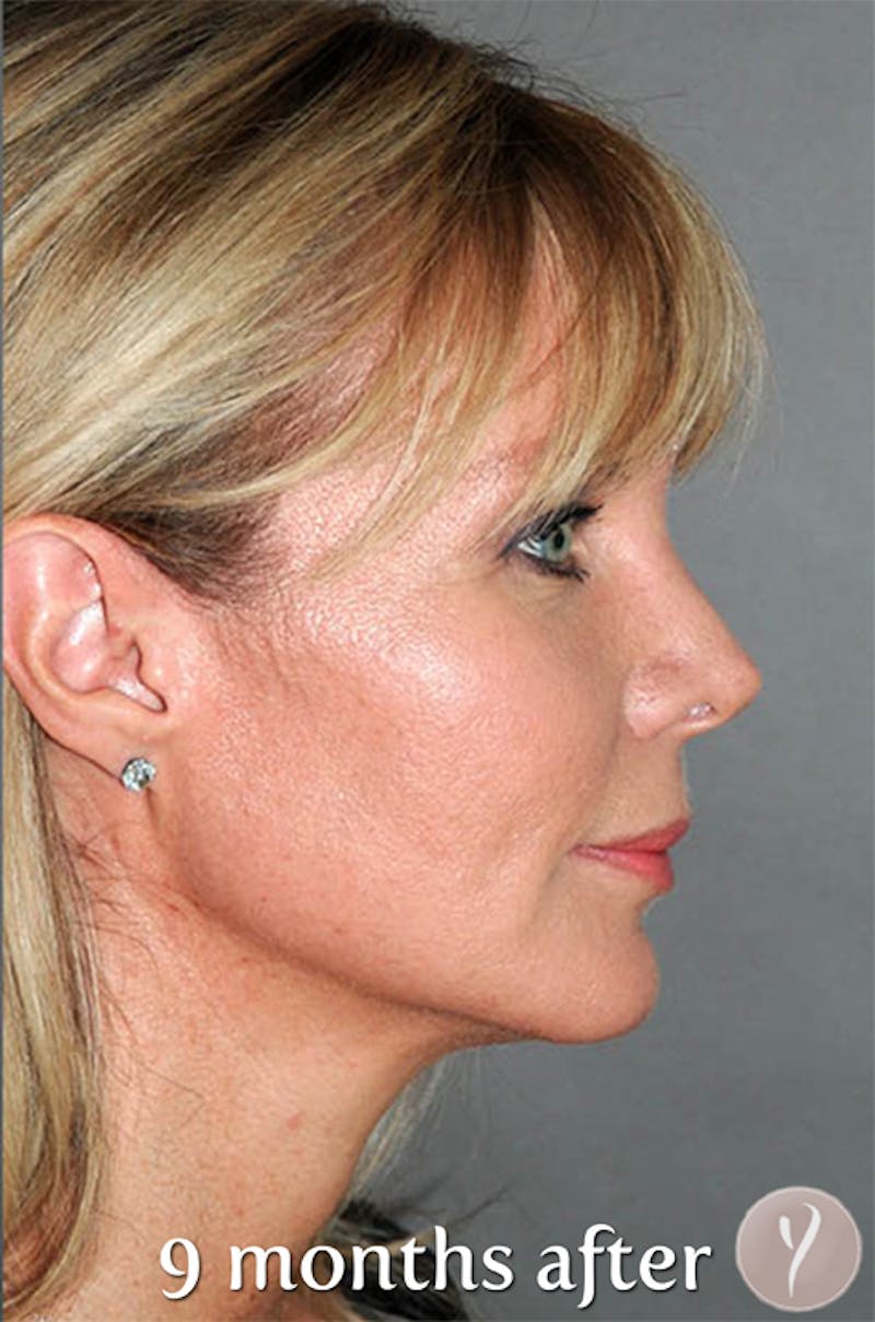 Y LIFT® Before & After Gallery - Patient 407546 - Image 6