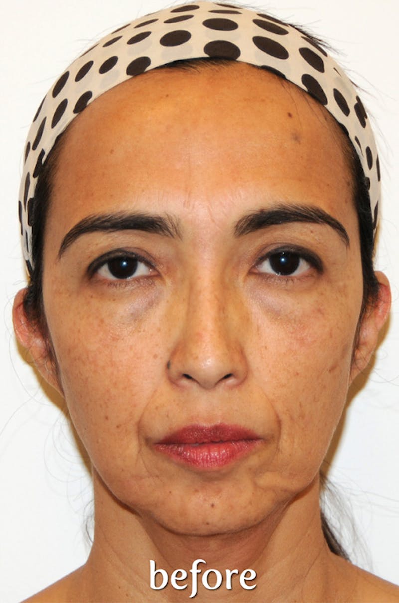 Y LIFT® Before & After Gallery - Patient 756019 - Image 1