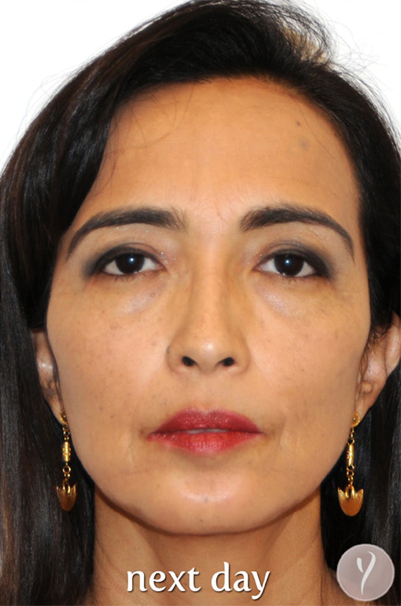 Y LIFT® Before & After Gallery - Patient 756019 - Image 2