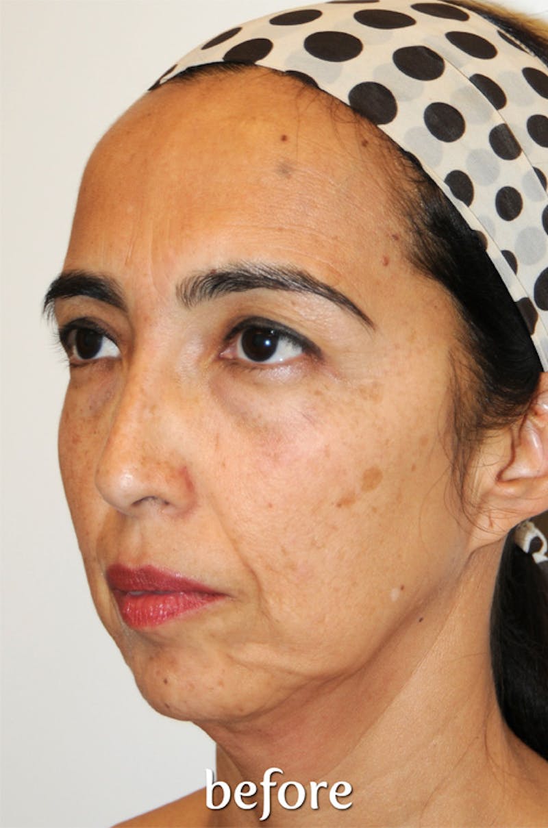 Y LIFT® Before & After Gallery - Patient 756019 - Image 3