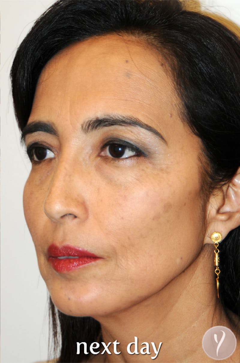 Y LIFT® Before & After Gallery - Patient 756019 - Image 4