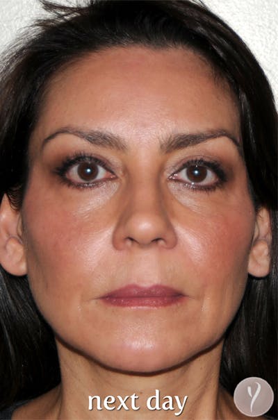 Y LIFT® Before & After Gallery - Patient 338422 - Image 2