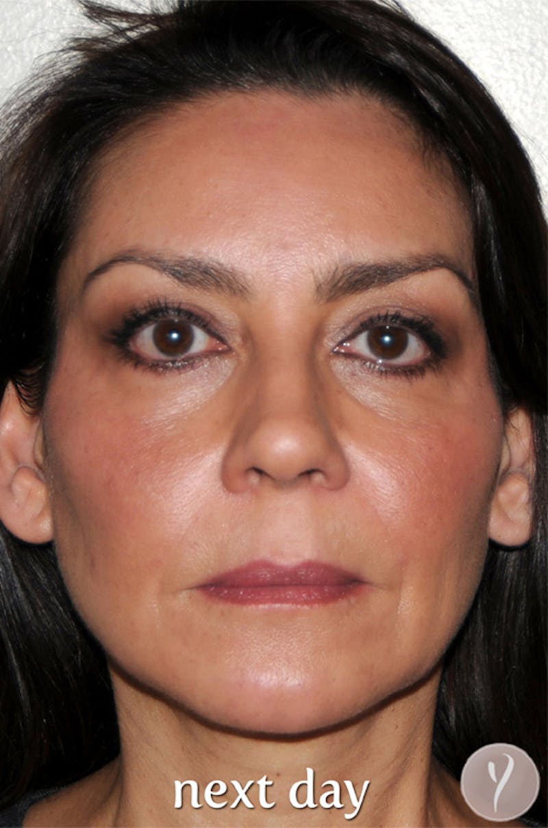 Y LIFT® Before & After Gallery - Patient 338422 - Image 2