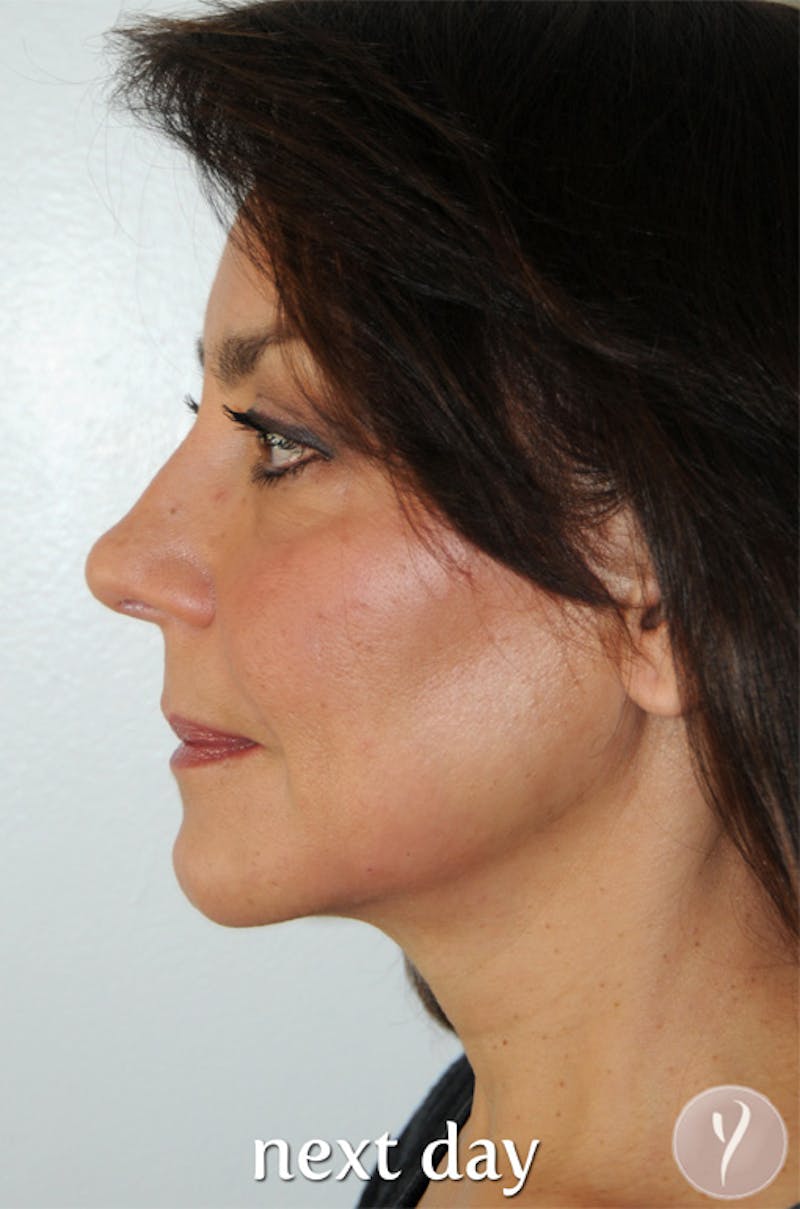 Y LIFT® Before & After Gallery - Patient 338422 - Image 4