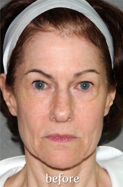 Y LIFT® Before & After Gallery - Patient 279580 - Image 1
