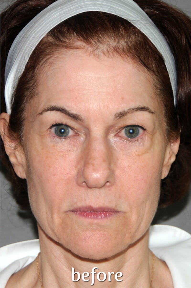 Y LIFT® Before & After Gallery - Patient 279580 - Image 1