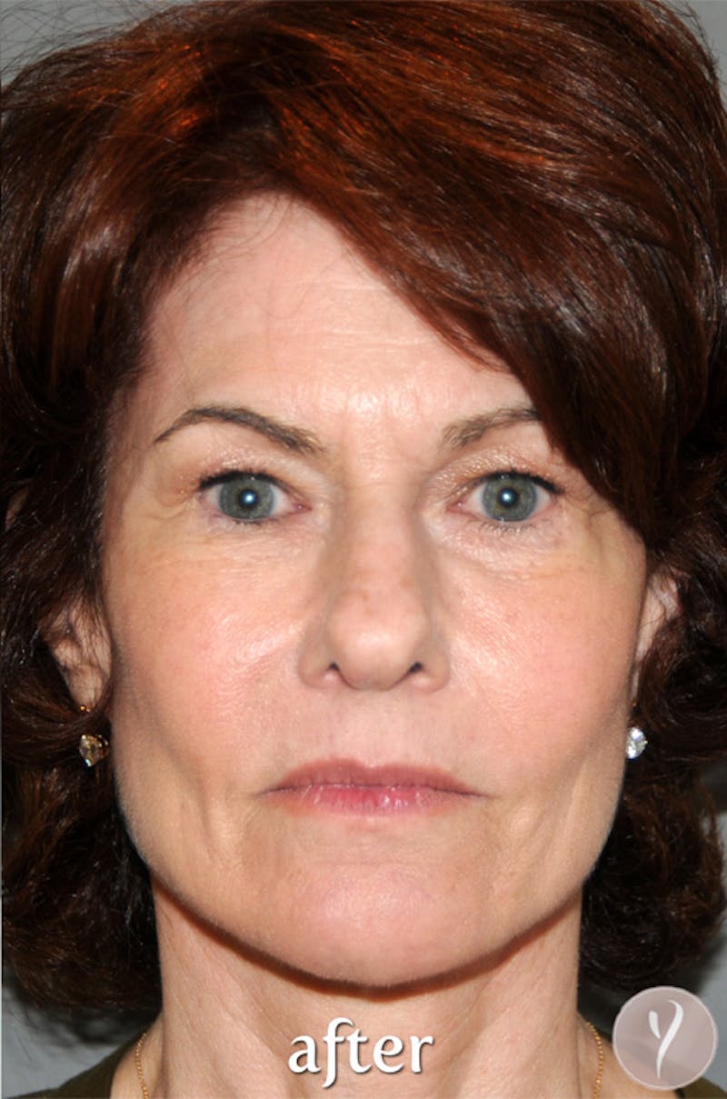 Y LIFT® Before & After Gallery - Patient 279580 - Image 2