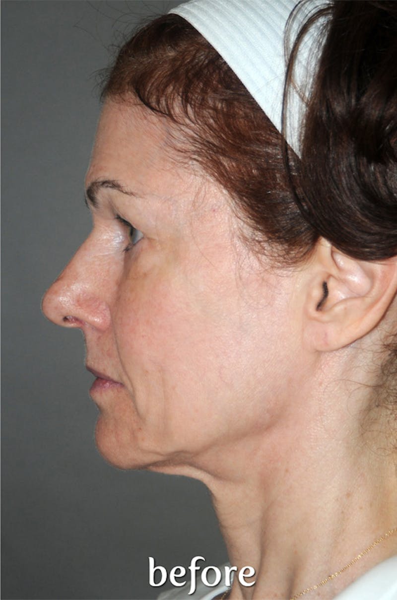 Y LIFT® Before & After Gallery - Patient 279580 - Image 3